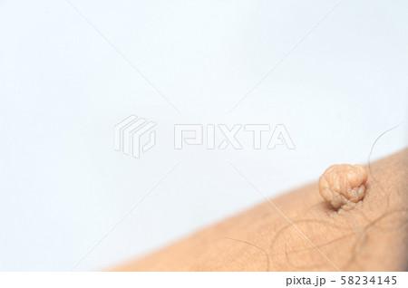 Pedunculated Mass skin tag or acrochondon or soft 58234145
