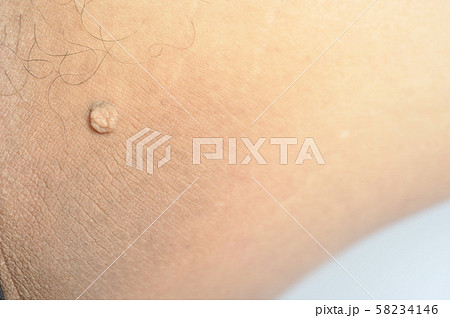 Pedunculated Mass skin tag or acrochondon or soft 58234146