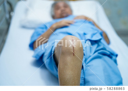 Asian senior or elderly old lady woman patient show her scars surgical total knee joint replacement Suture wound surgery arthroplasty on bed in nursing hospital ward Asian senior or elderly old lady woman patient show her scars surgical total knee joint replacement Suture wound surgery arthroplasty on bed in nursing hospital ward 58288863