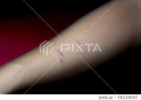 Scab wound on arm 58320095