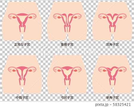 子宮畸形 子宮畸形 58325421