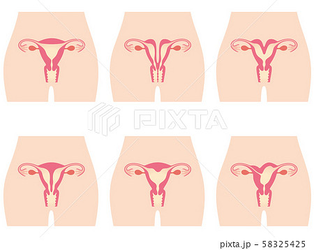 子宮奇形 58325425