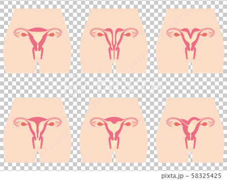 子宮畸形 子宮畸形 58325425