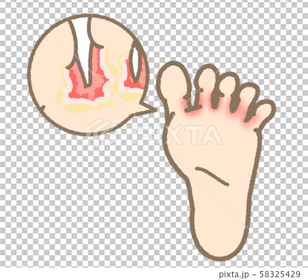 Athlete's Symptom Symptom Type Mild Expression 58325429