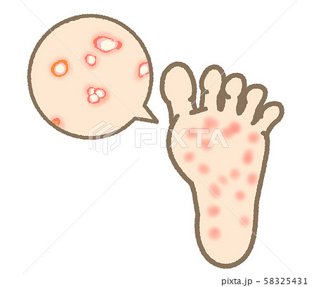 水虫 症状 小水疱型 表現マイルド 水虫 症状 小水疱型 表現マイルド 58325431