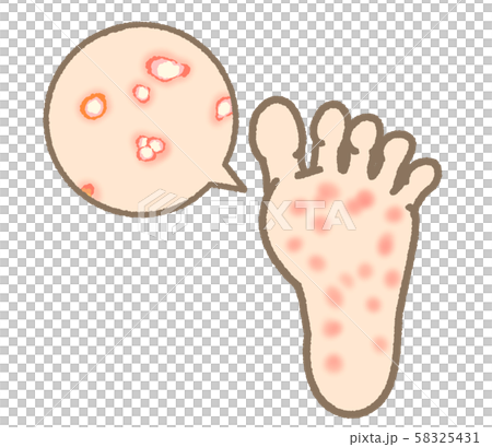 Athlete's foot symptom small blister type expression mild 58325431