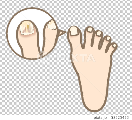 Athlete's foot symptom nail ringworm mild expression 58325433