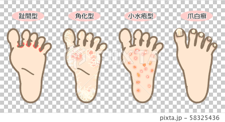 帶有字母的運動員腳症狀列表 58325436