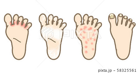 水虫　症状一覧　表現マイルド 58325561