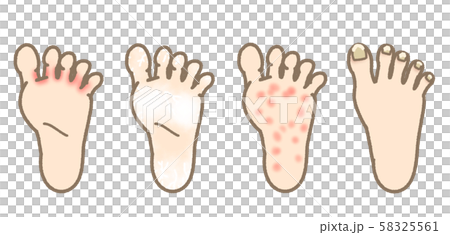 水虫　症状一覧　表現マイルド 58325561