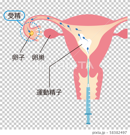 人工授精 不妊治療 人工授精 不妊治療 58382497