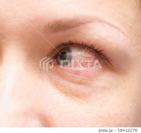 irritated eye irritated eye 58412276