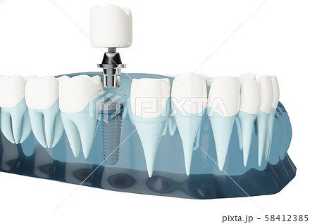 Component of Dental implants. Blue color transparent. 3d illustrations Component of Dental implants. Blue color transparent. 3d illustrations 58412385