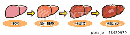 肝炎 肝硬変 進行図 文字付 肝炎 肝硬変 進行図 文字付 58420970