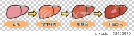 肝炎 肝硬変 進行図 文字付 肝炎 肝硬変 進行図 文字付 58420970