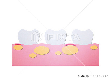 unhealthy teeth because gingivitis with abscess in gum and dental plaque or tartar unhealthy teeth because gingivitis with abscess in gum and dental plaque or tartar 58439542