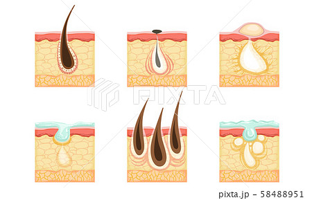 Set of skin images with hair roots, acne and sweat. Vector illustration. 58488951