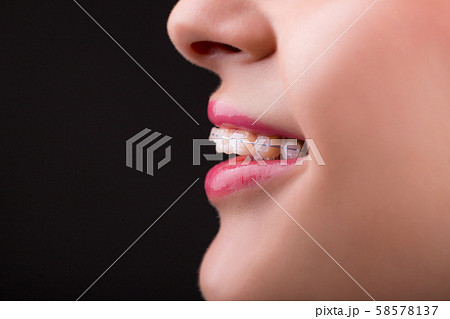 Braces. Beautiful Woman healthy smile close up. Braces. Beautiful Woman healthy smile close up. 58578137