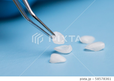 Dentist holds a veneer with tweezers against a Dentist holds a veneer with tweezers against a 58578361