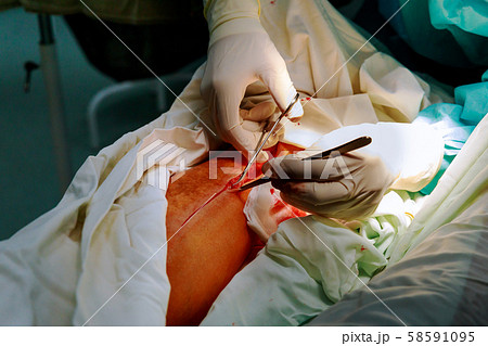 Doctor in the operating room for surgical leg Doctor in the operating room for surgical leg 58591095