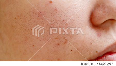 acne on the woman face 58601297