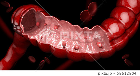 3d illustration of Colon polyps. Polyp in the intestine. isolated black.. 58612804
