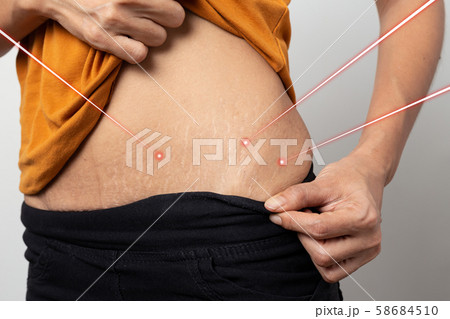Laser removal treatment concept, Women Show off the belly after birth. Stretch Marks on white background, 58684510