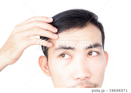 Young man serious hair loss problem for health Young man serious hair loss problem for health 58696971