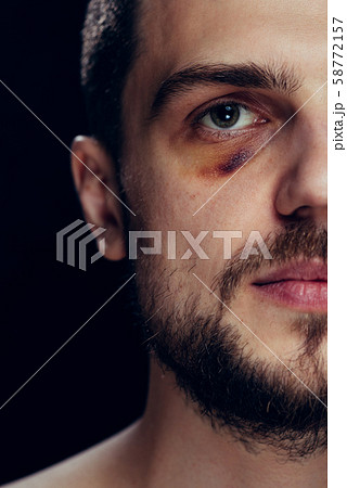 Violence fight eye hematoma shiner close-up. Portrait of a man with bruised skin and black eye. Violence fight eye hematoma shiner close-up. Portrait of a man with bruised skin and black eye. 58772157