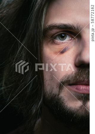 Young man with bruise black eye hematoma, violence victim concept. 58772162