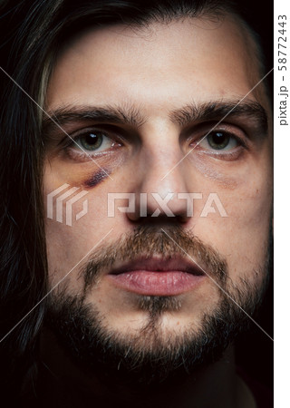 Man with bruise black eye shiner hematoma. Domestic violence male victim concept. 58772443