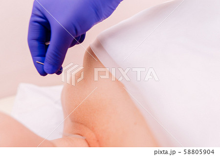 Young woman getting acupuncture treatment Young woman getting acupuncture treatment 58805904