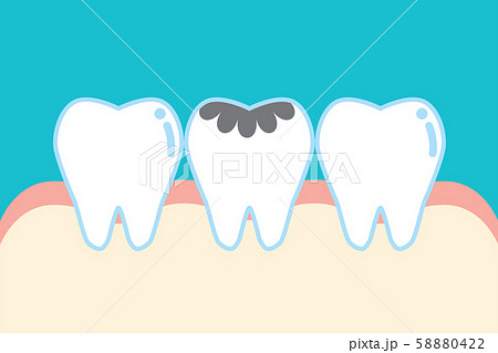 虫歯のかわいい歯のイラスト cute cartoon implant tooth illustrat 58880422