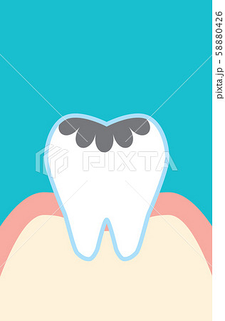 虫歯のかわいい歯のイラスト Cute Cartoon Implant Tooth Illustratのイラスト素材