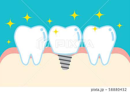インプラントのかわいい歯のイラスト Cute Cartoon Implant Toothのイラスト素材