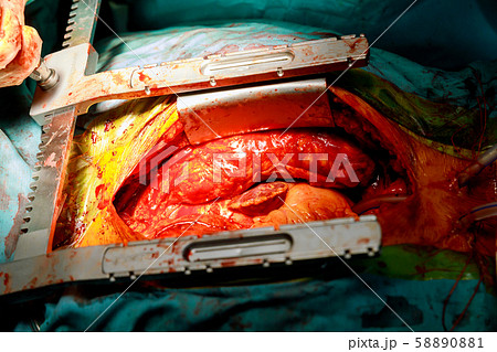 Human heart close-up in opened chest during the Human heart close-up in opened chest during the 58890881