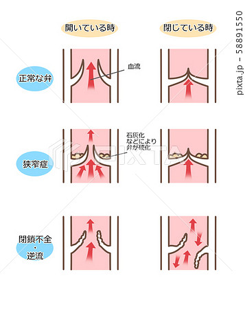 心臓弁膜症 弁膜の図 断面図 文字付 色違いのイラスト素材