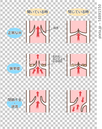 心臓弁膜症 弁膜の図 断面図 文字付 色違いのイラスト素材