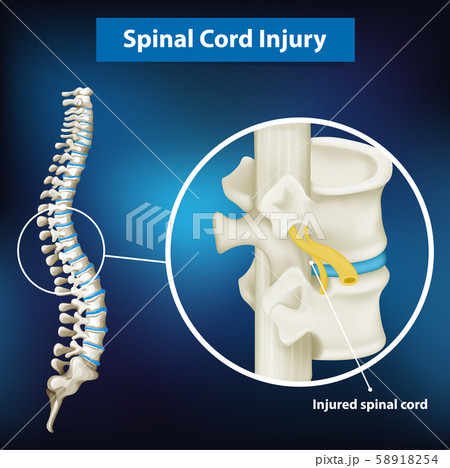 Diagram showing spinal cord injury 58918254