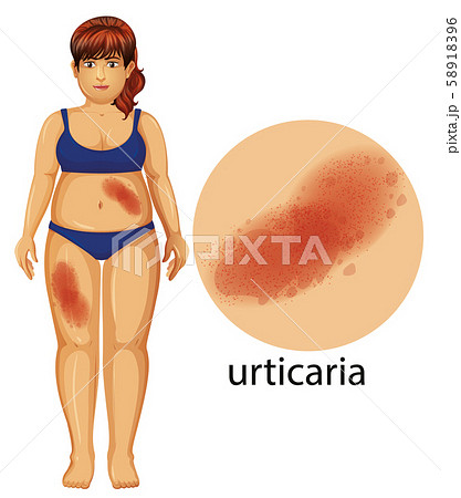 Woman with urticaria problem Woman with urticaria problem 58918396