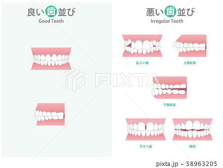 よい歯並び 悪い歯並びのイラストのイラスト素材 5635 よい歯並び 悪い歯並びのイラストのイラスト素材 5635