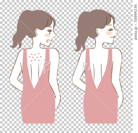 Back acne female before and after skin care skin care illustration Back acne female before and after skin care skin care illustration 58994236