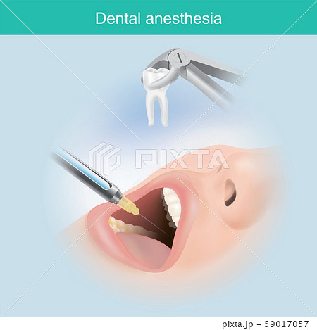 Dental anaesthesia. A jet injection aims a liquid 59017057