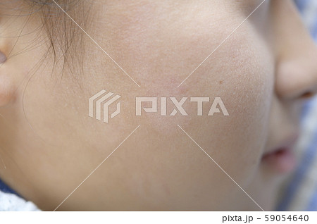 皮膚病（ぜにたむし 体部白癬）治療後 59054640