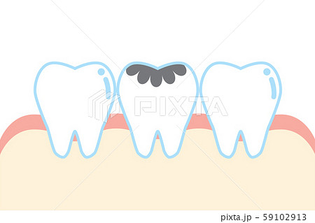 虫歯のかわいい歯のイラスト Cute Cartoon Decayed Tooth Illustratのイラスト素材