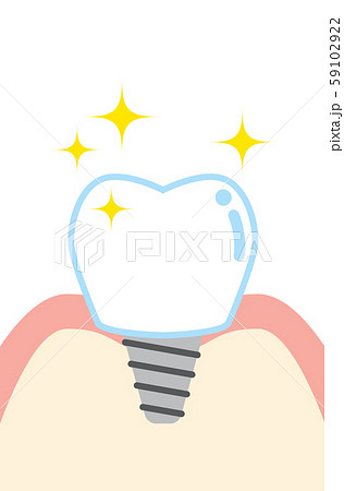インプラントのかわいい歯のイラスト Cute Cartoon Illustration Implanのイラスト素材