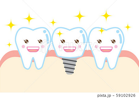 インプラントのかわいい歯のイラスト Cute Cartoon Illustration Implanのイラスト素材
