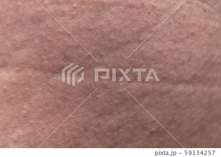 Pattern of human's skin with the stretch marks, closeup photo 59134257