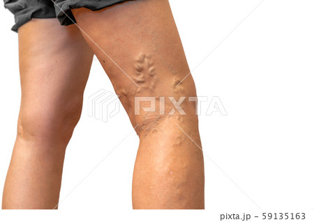 Legs pain concept - legs tied with rope isolated on white Legs pain concept - legs tied with rope isolated on white 59135163