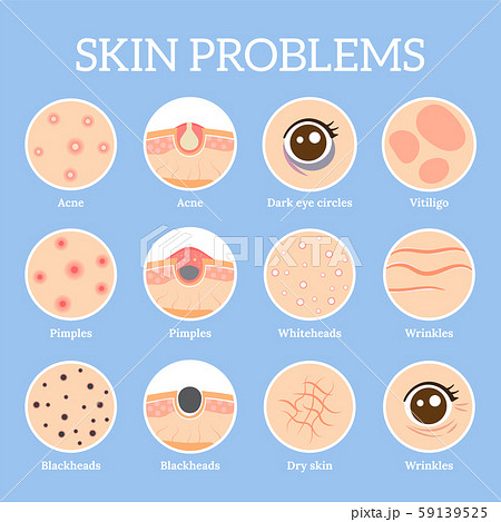 Skin problems. Ages wrinkles problem, face skin infection treatment and dark circles under eyes 59139525